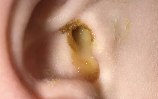 Ear Discharge